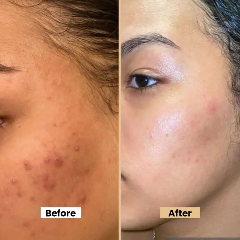 Anti Acne Cream Ffor Blemishes Scars & Breakouts Hydrating Formula With Aloe Vera & Neem Anti-Inflammatory