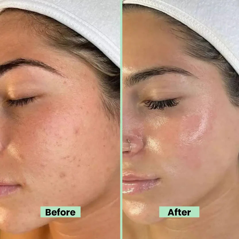 Aloe Vera Face Serum Hydrating & Brightening Skin With Hyaluronic Acid & Green Tea Anti-Acne Anti-Inflammatory