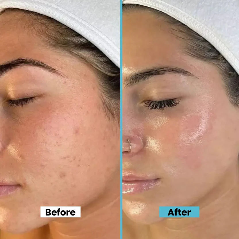 Hyaluronic Acid Serum Advanced Hydrating & Anti-Aging Facial Serum With Vitamin B3 Minimizes Fine Lines Tightens Pores